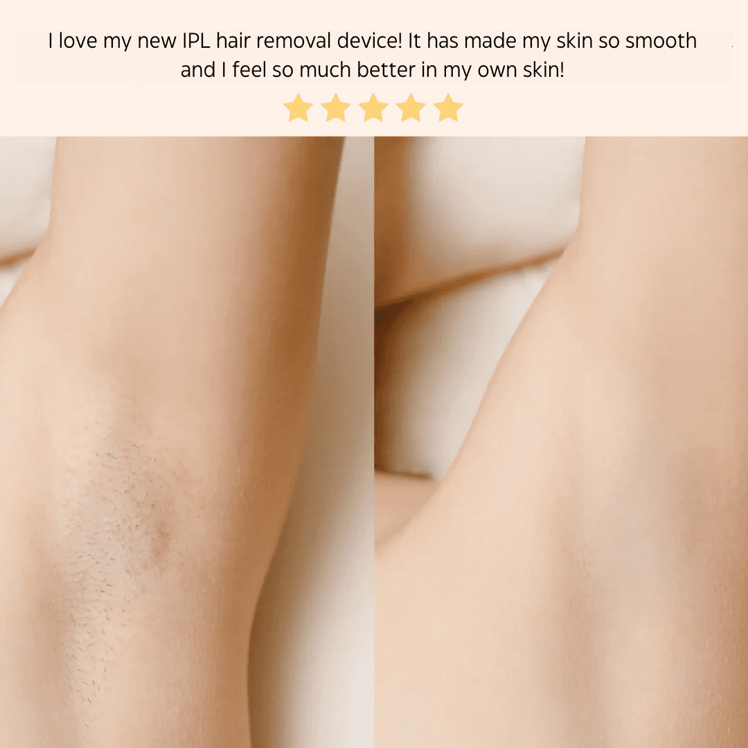 IPL Hair Removal Handset System – A Laser-Free Alternative image 7