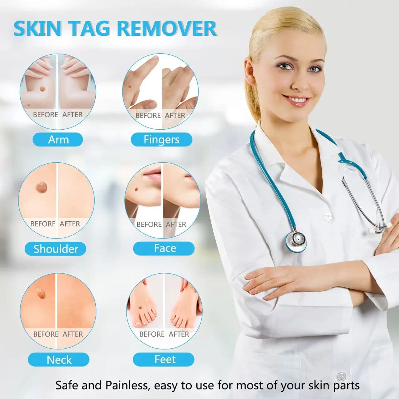 3-in-1 Painless Skin Tag Removal Kit, At-Home Micro Tool for Tags, Moles & Warts image 2