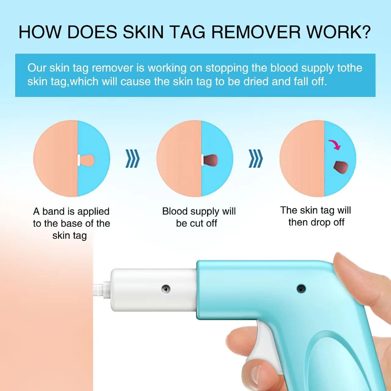 3-in-1 Painless Skin Tag Removal Kit, At-Home Micro Tool for Tags, Moles & Warts image 3