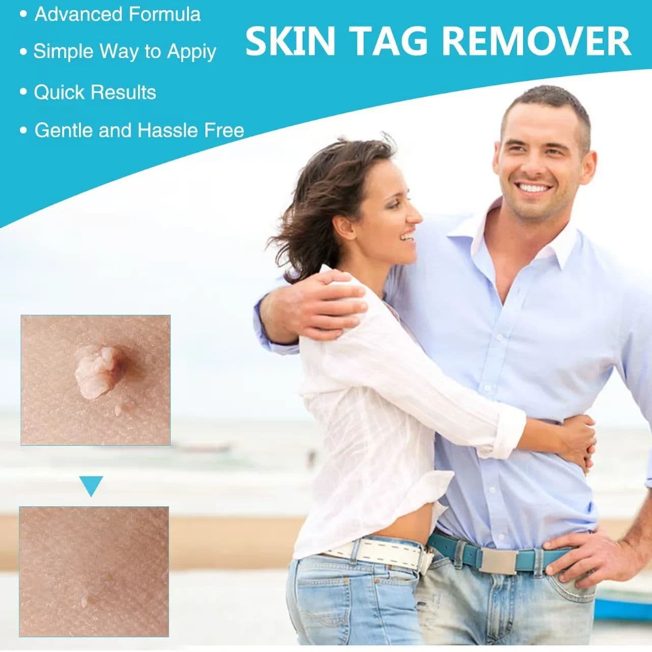 3-in-1 Painless Skin Tag Removal Kit, At-Home Micro Tool for Tags, Moles & Warts image 4